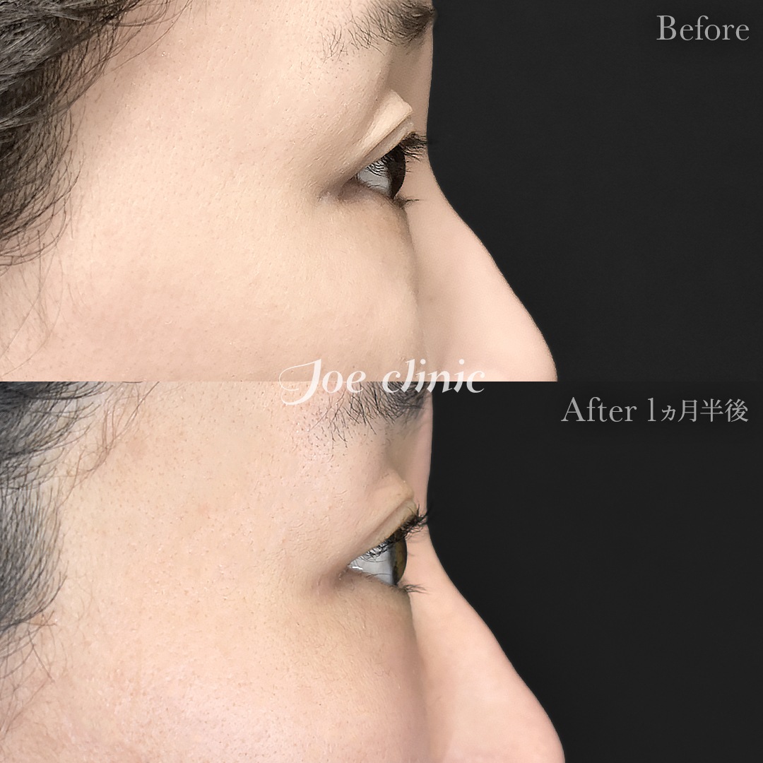 【30代女性】目の下のクマ取り（裏ハムラ法）｜1ヵ月半後