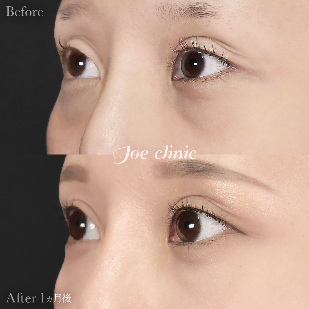 【20代女性】目の下のクマ取り（裏ハムラ法）｜1ヵ月後