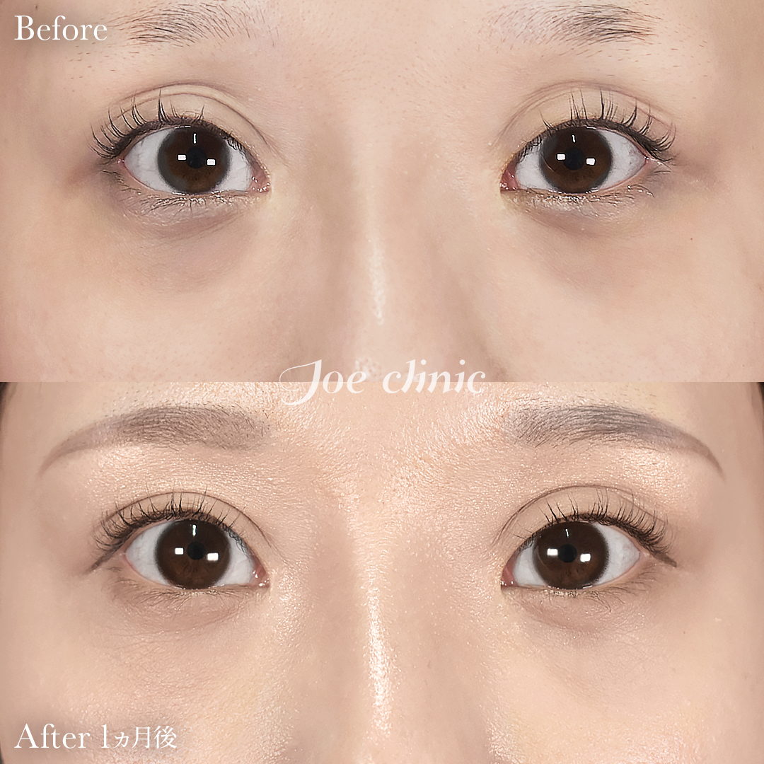 【20代女性】目の下のクマ取り（裏ハムラ法）｜1ヵ月後