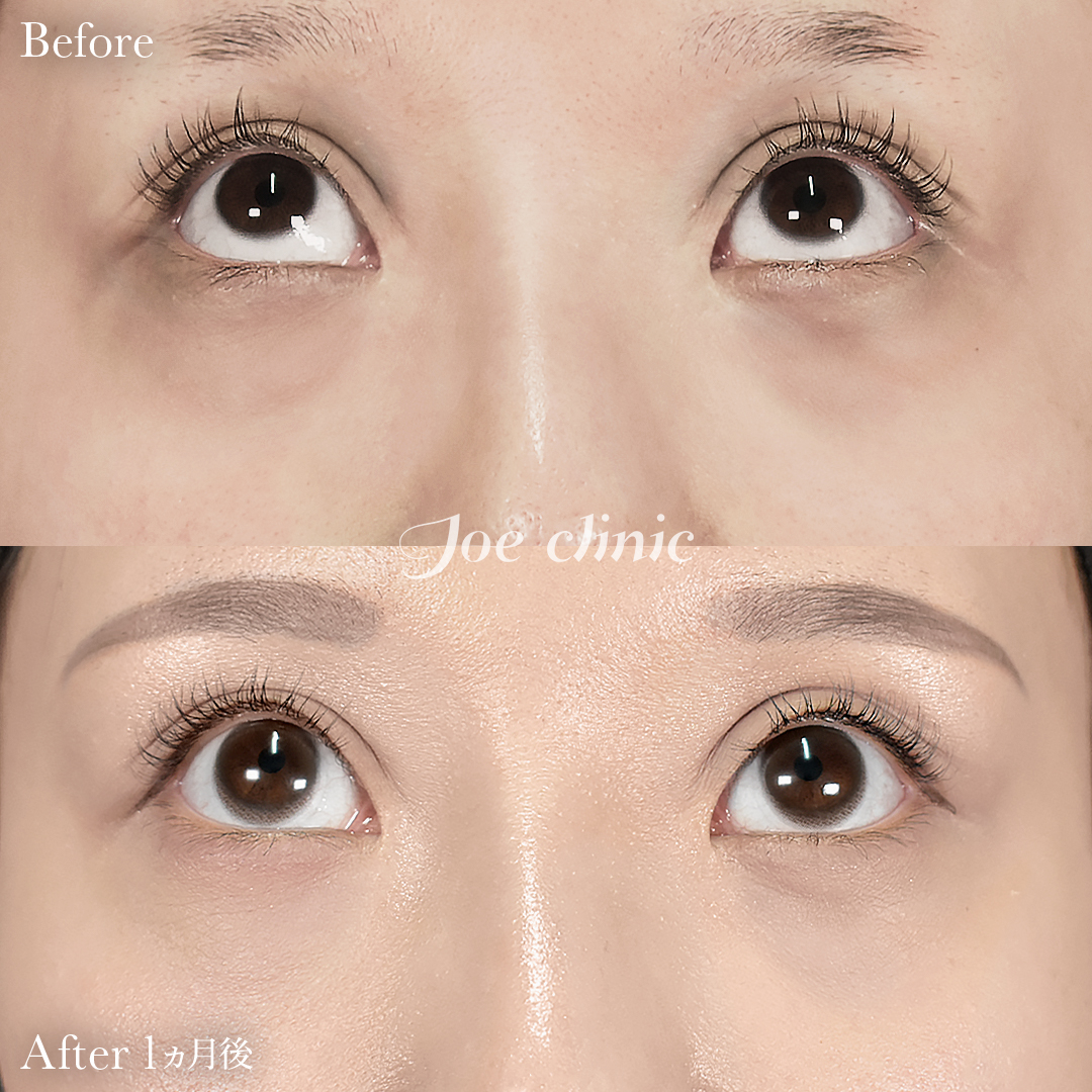 【20代女性】目の下のクマ取り（裏ハムラ法）｜1ヵ月後