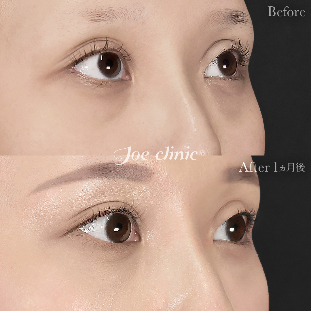 【20代女性】目の下のクマ取り（裏ハムラ法）｜1ヵ月後