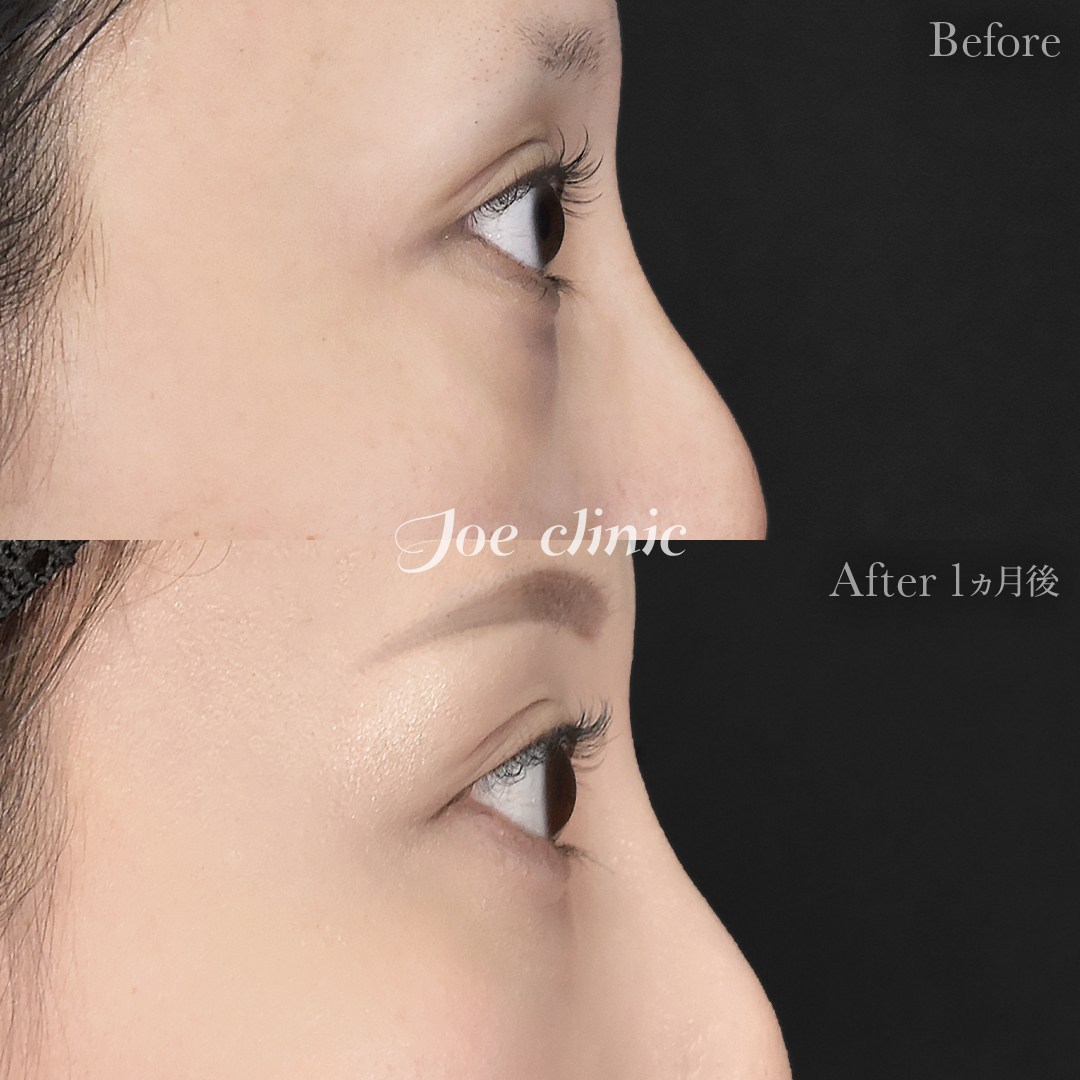 【20代女性】目の下のクマ取り（裏ハムラ法）｜1ヵ月後