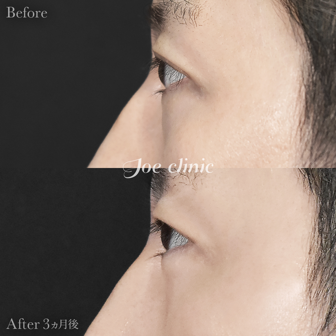 【30代男性】目の下のクマ取り(脂肪取り術)|3ヵ月後