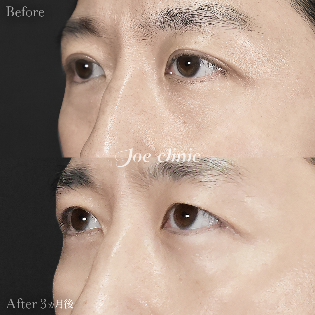 【30代男性】目の下のクマ取り(脂肪取り術)|3ヵ月後