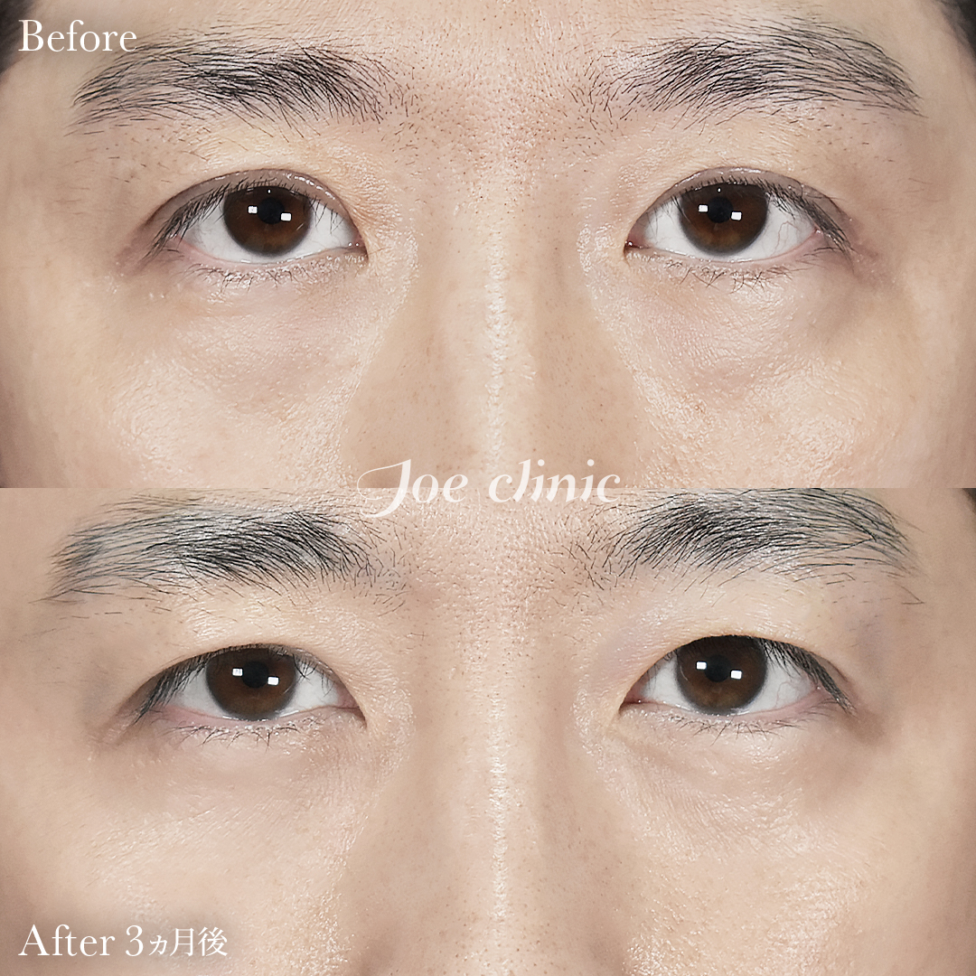 【30代男性】目の下のクマ取り（脂肪取り術）｜3ヵ月後