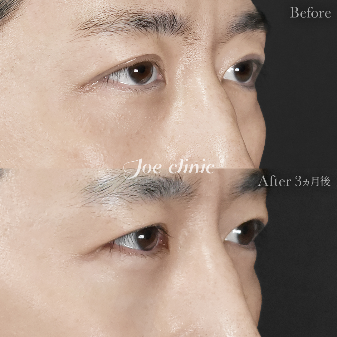 【30代男性】目の下のクマ取り(脂肪取り術)|3ヵ月後