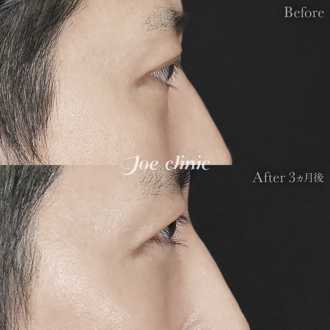 【30代男性】目の下のクマ取り(脂肪取り術)|3ヵ月後