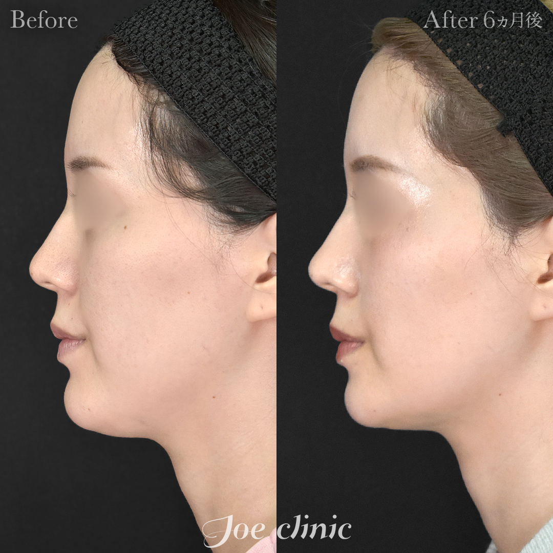 【30代女性】超音波骨削り術（顎）＋顔の脂肪吸引（顎下）｜6ヵ月後