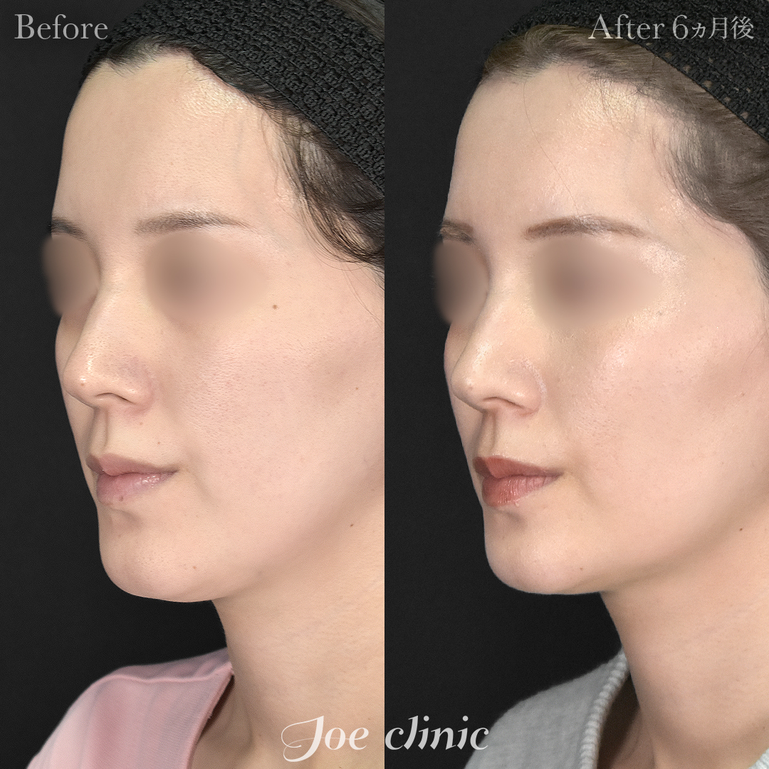 【30代女性】超音波骨削り術（顎）＋顔の脂肪吸引（顎下）｜6ヵ月後