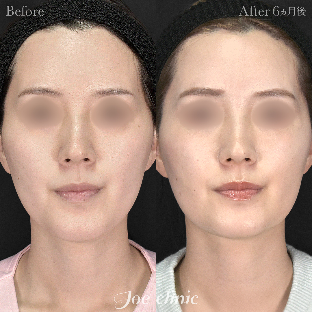 【30代女性】超音波骨削り術（顎）＋顔の脂肪吸引（顎下）｜6ヵ月後