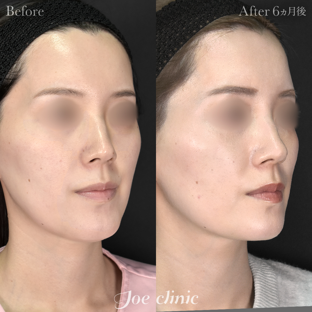 【30代女性】超音波骨削り術（顎）＋顔の脂肪吸引（顎下）｜6ヵ月後