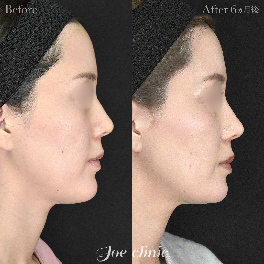 【30代女性】超音波骨削り術（顎）＋顔の脂肪吸引（顎下）｜6ヵ月後