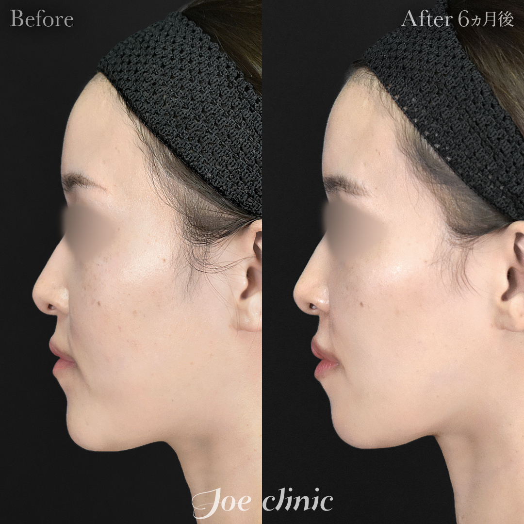 【20代女性】骨削り術（顎）＋顔の脂肪吸引（フェイスライン＋顎下）｜6ヵ月後