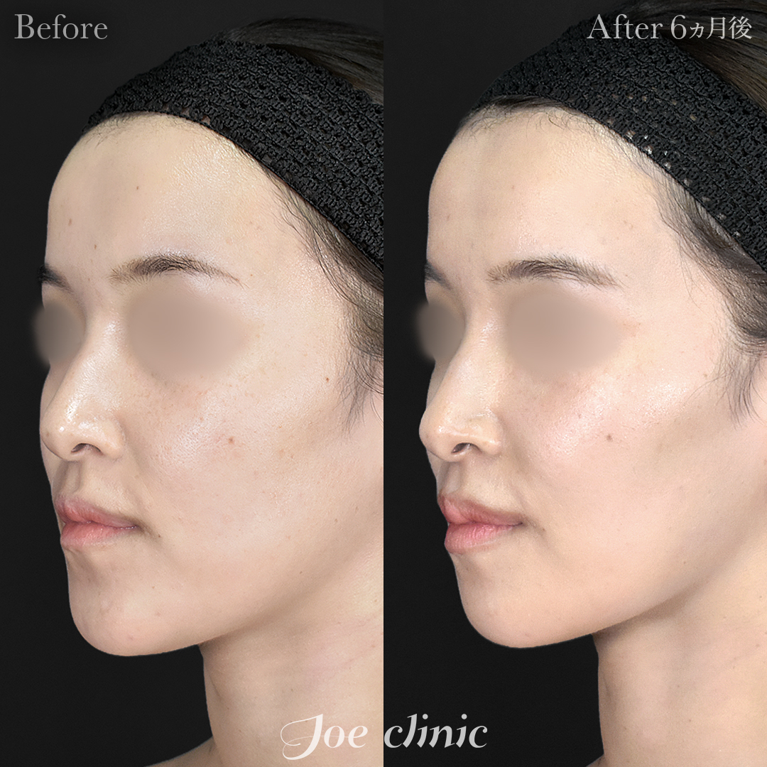 【20代女性】骨削り術（顎）＋顔の脂肪吸引（フェイスライン＋顎下）｜6ヵ月後