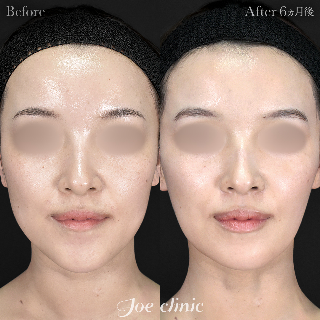 【20代女性】骨削り術（顎）＋顔の脂肪吸引（フェイスライン＋顎下）｜6ヵ月後