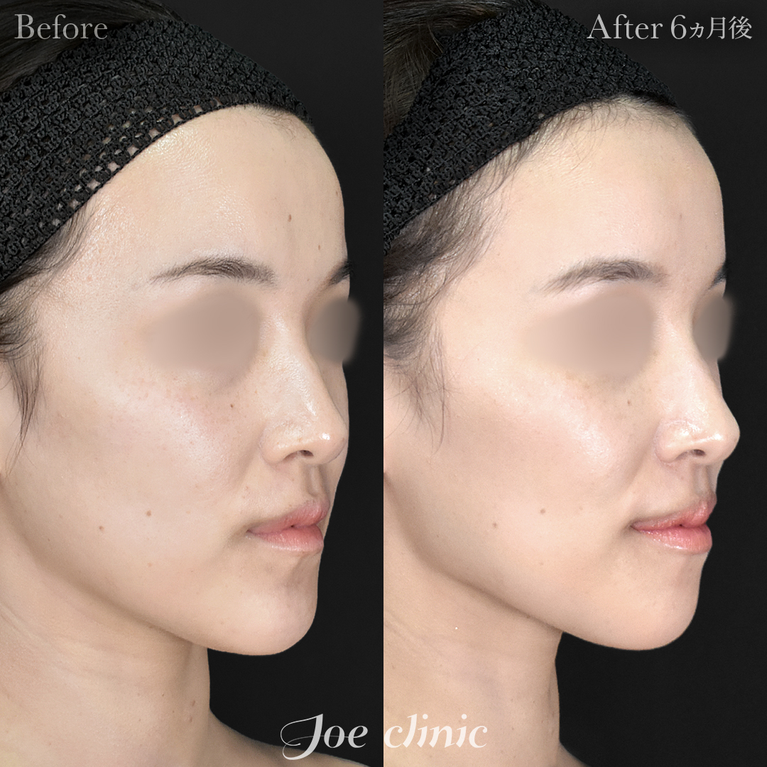 【20代女性】骨削り術（顎）＋顔の脂肪吸引（フェイスライン＋顎下）｜6ヵ月後