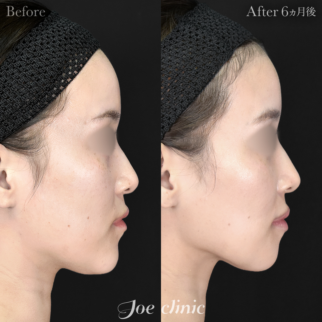 【20代女性】骨削り術（顎）＋顔の脂肪吸引（フェイスライン＋顎下）｜6ヵ月後