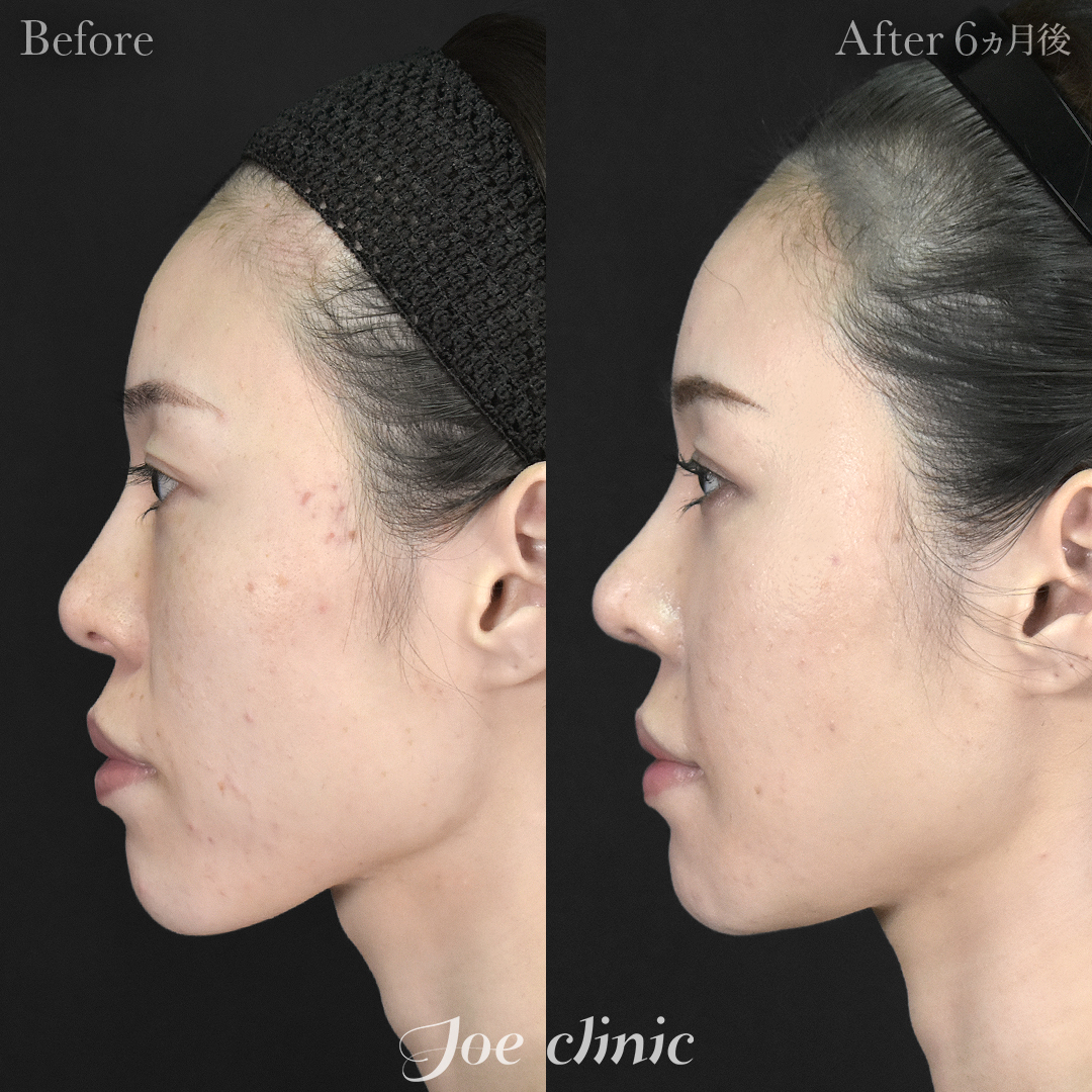 【30代女性・他院修正】鼻フルコース（鼻複合自家組織移植術 肋軟骨使用）＋他院鼻プロテーゼ入替＋小鼻縮小術＋貴族手術＋骨削り術（顎）｜6ヵ月後