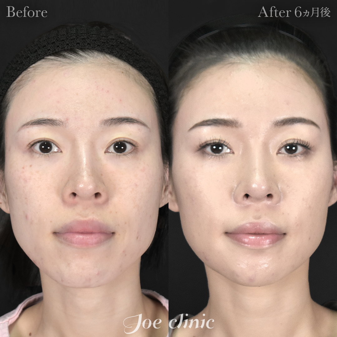 【30代女性・他院修正】鼻フルコース（鼻複合自家組織移植術 肋軟骨使用）＋他院鼻プロテーゼ入替＋小鼻縮小術＋貴族手術＋骨削り術（顎）｜6ヵ月後