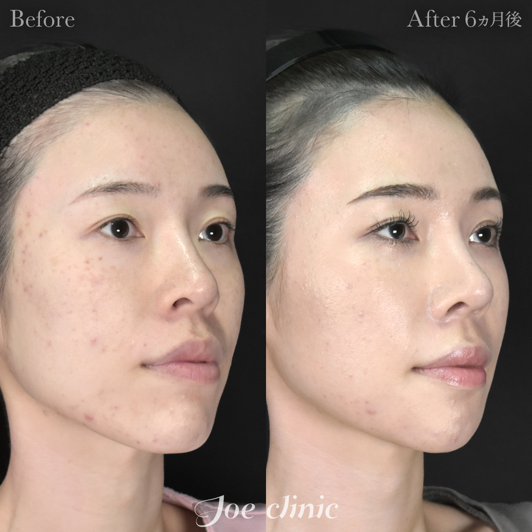 【30代女性・他院修正】鼻フルコース（鼻複合自家組織移植術 肋軟骨使用）＋他院鼻プロテーゼ入替＋小鼻縮小術＋貴族手術＋骨削り術（顎）｜6ヵ月後