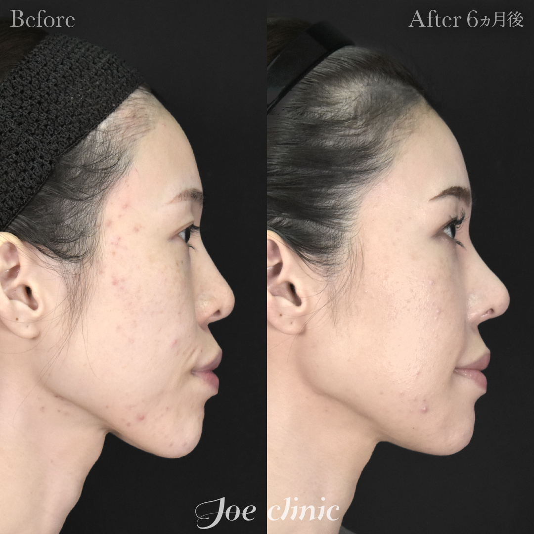 【30代女性・他院修正】鼻フルコース（鼻複合自家組織移植術 肋軟骨使用）＋他院鼻プロテーゼ入替＋小鼻縮小術＋貴族手術＋骨削り術（顎）｜6ヵ月後