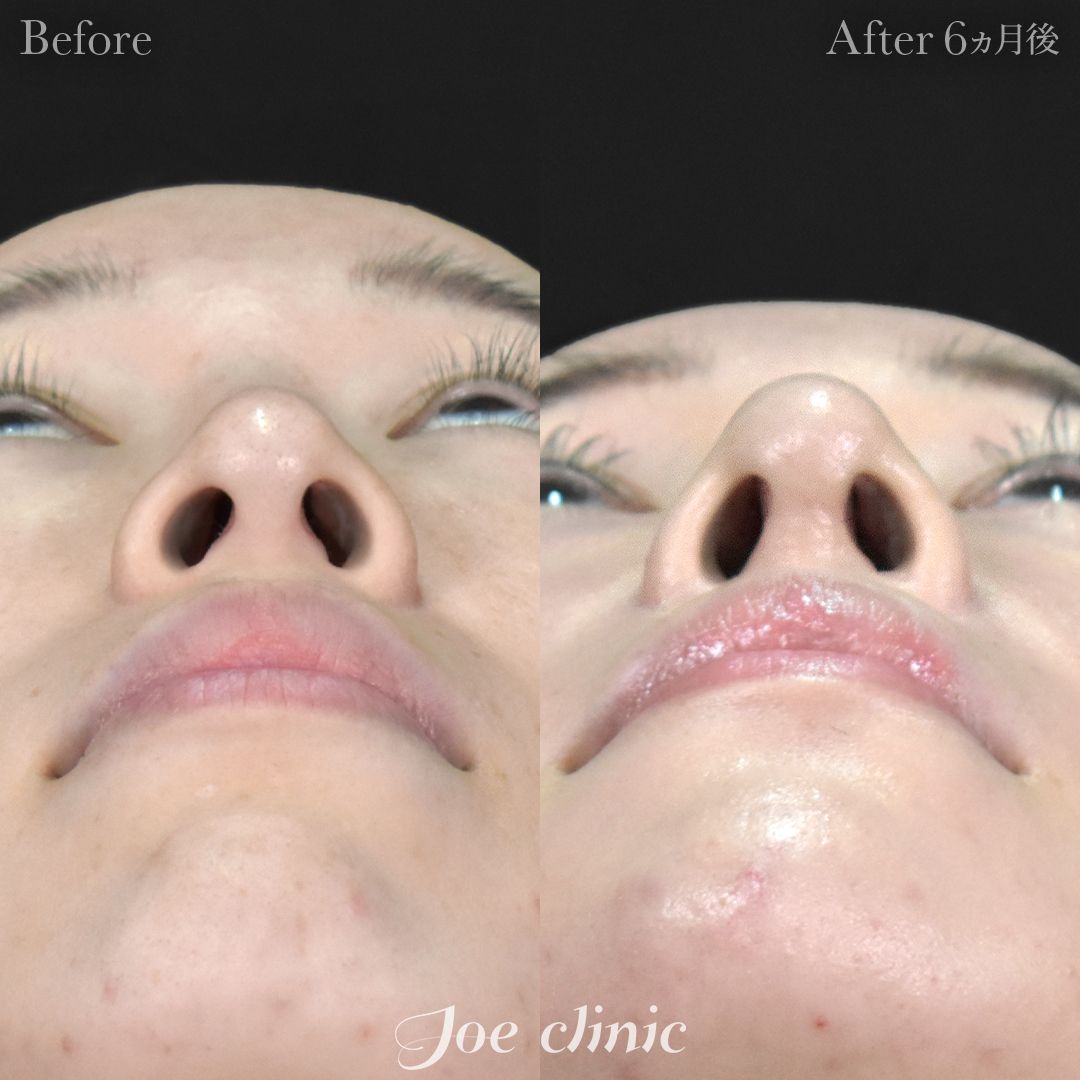 【30代女性・他院修正】鼻フルコース（鼻複合自家組織移植術 肋軟骨使用）＋他院鼻プロテーゼ入替＋小鼻縮小術＋貴族手術＋骨削り術（顎）｜6ヵ月後