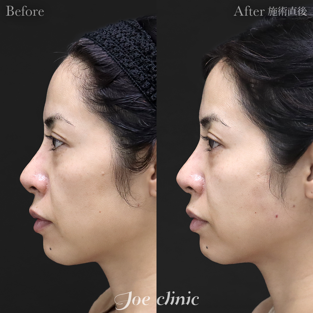 【40代女性】ヒアルロン酸注入（頬）｜施術直後