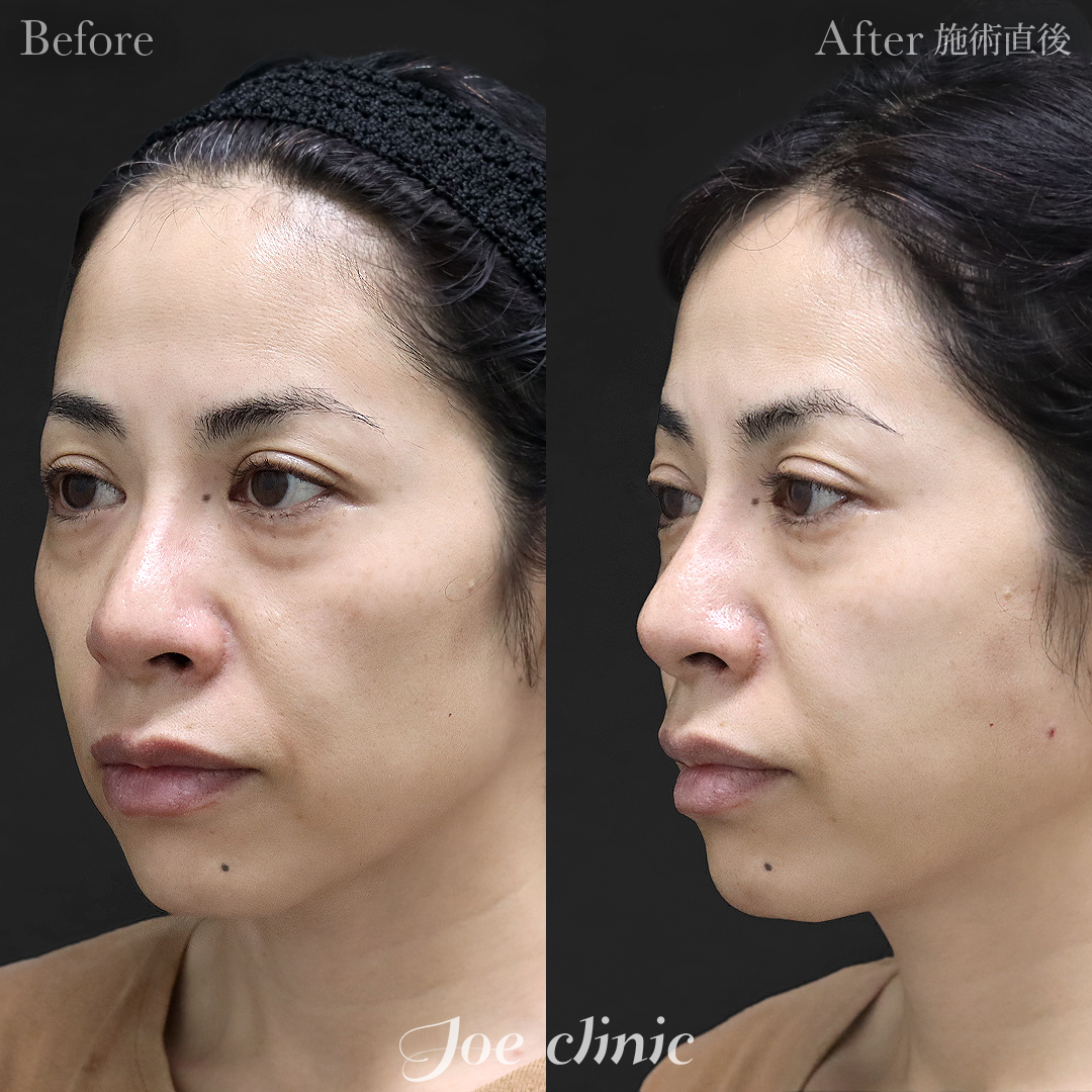 【40代女性】ヒアルロン酸注入（頬）｜施術直後