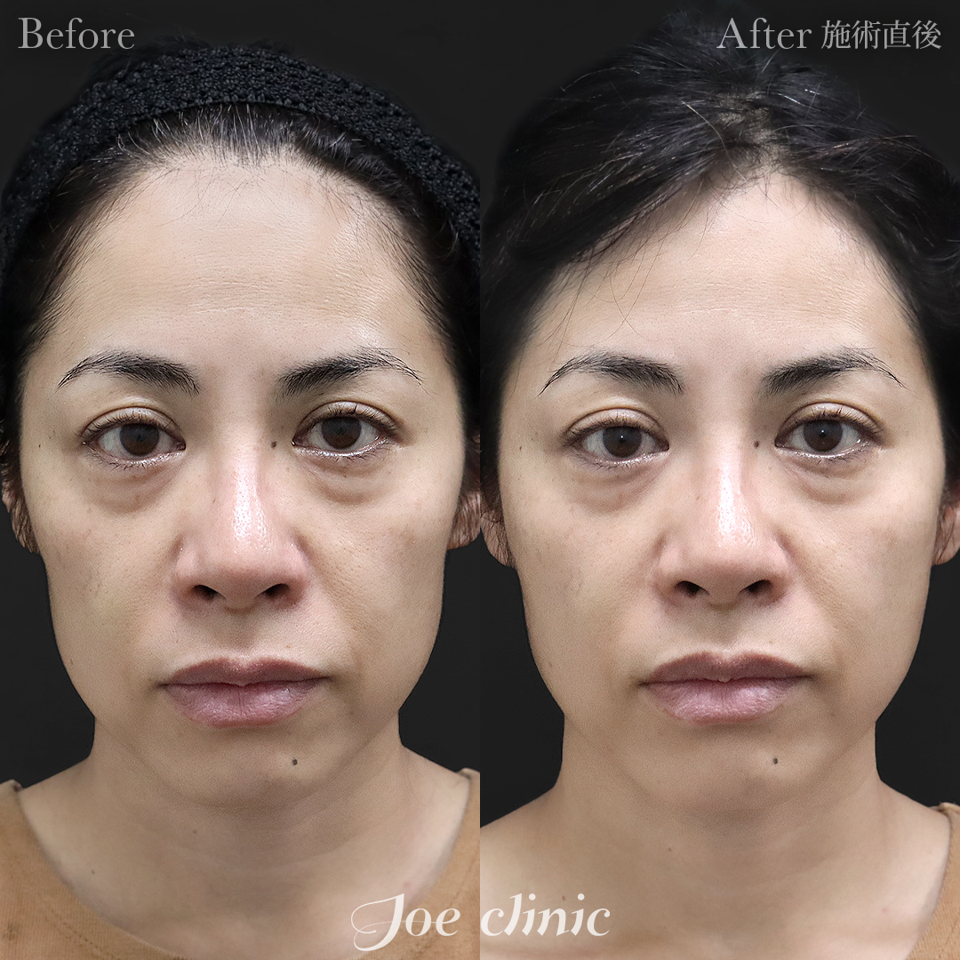 【40代女性】ヒアルロン酸注入（頬）｜施術直後