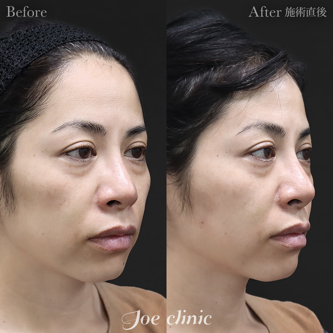 【40代女性】ヒアルロン酸注入（頬）｜施術直後