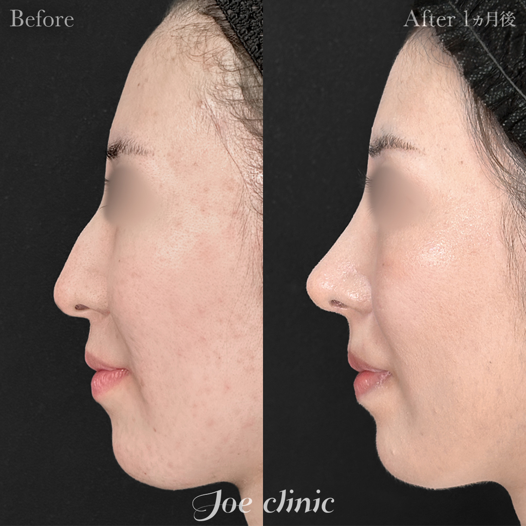 【20代女性・他院修正】他院異物除去＋鼻フルコース（鼻複合自家組織移植術）＋鼻骨骨削り術＋鼻骨骨切り幅寄せ術｜1ヵ月後