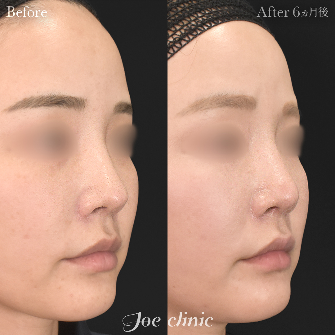 【30代女性・他院修正】他院異物除去＋他院耳介軟骨抜去修正＋人中剥離＋鼻筋筋膜移植｜1ヵ月後