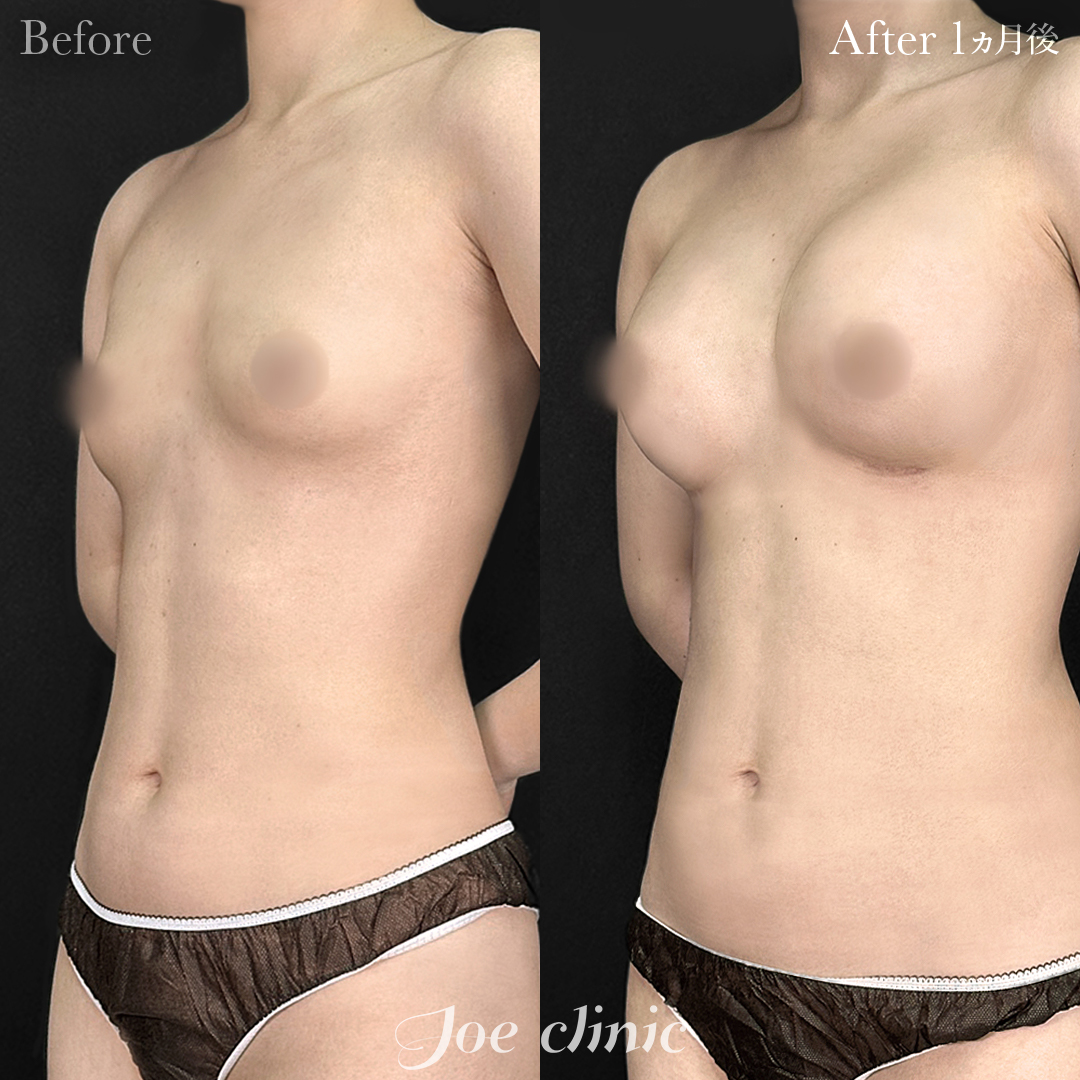 【20代女性】シリコンバッグ豊胸モティバ2（275cc×左右）胸下切開 デュアルプレーン法｜1ヵ月後