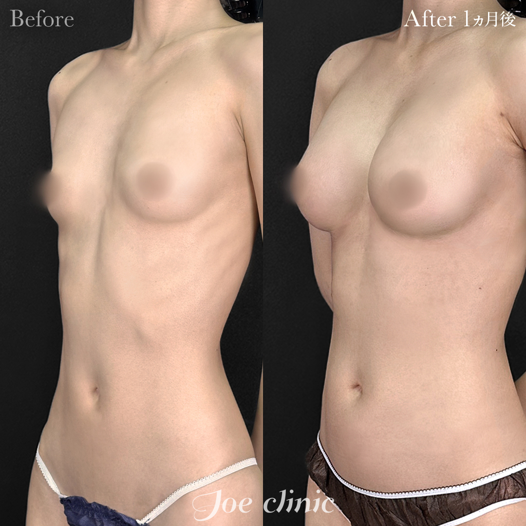【20代女性】ハイブリッド豊胸（シリコンバッグ豊胸＋脂肪幹細胞注入豊胸）胸下切開 デュアルプレーン法｜1ヵ月後
