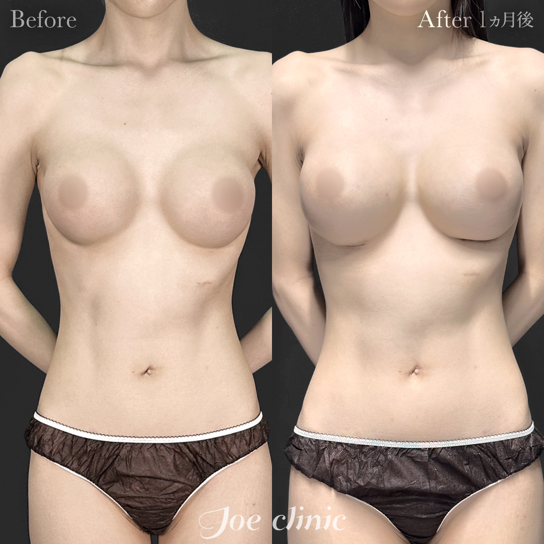【20代女性・他院修正】他院バッグ入れ替え（325cc×左右） 胸下切開 デュアルプレーン法｜1ヵ月後