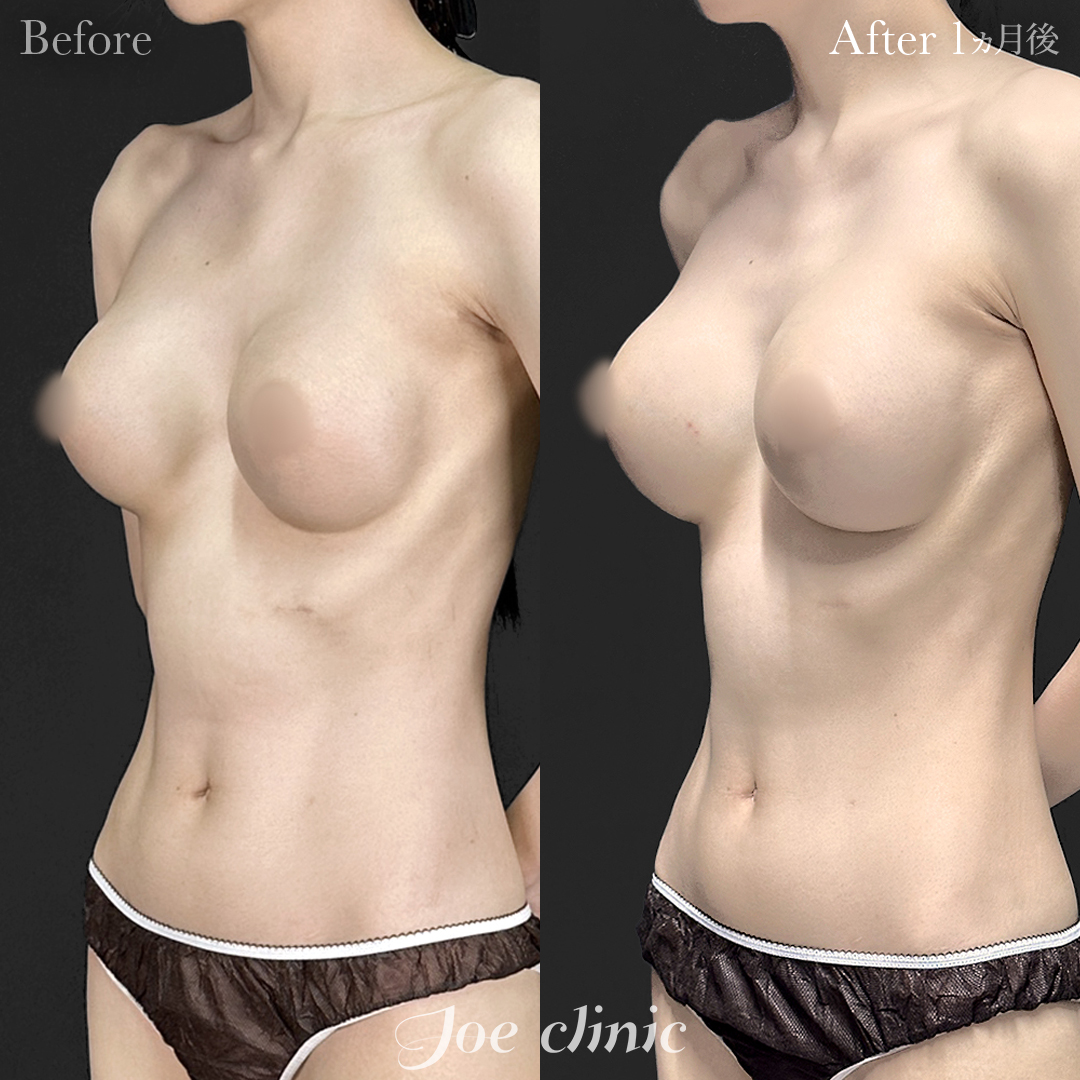 【20代女性・他院修正】他院バッグ入れ替え（325cc×左右） 胸下切開 デュアルプレーン法｜1ヵ月後