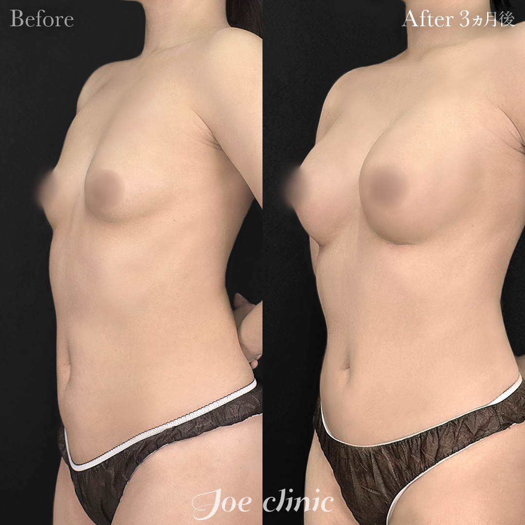 【40代女性】シリコンバッグ豊胸モティバ2（335cc×左右） 胸下切開 デュアルプレーン法｜3ヵ月後