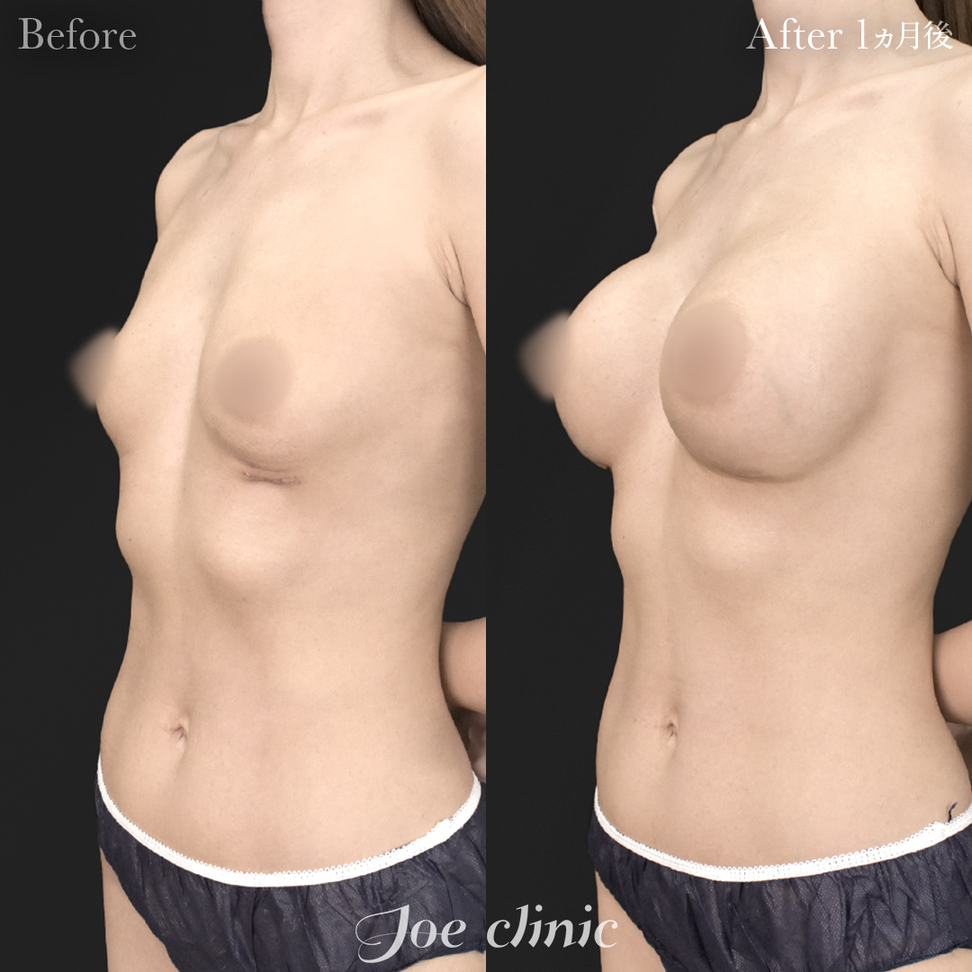 【30代女性・他院修正】アクアフィリング除去後のシリコンバッグ豊胸（290cc×左右）｜1ヵ月後