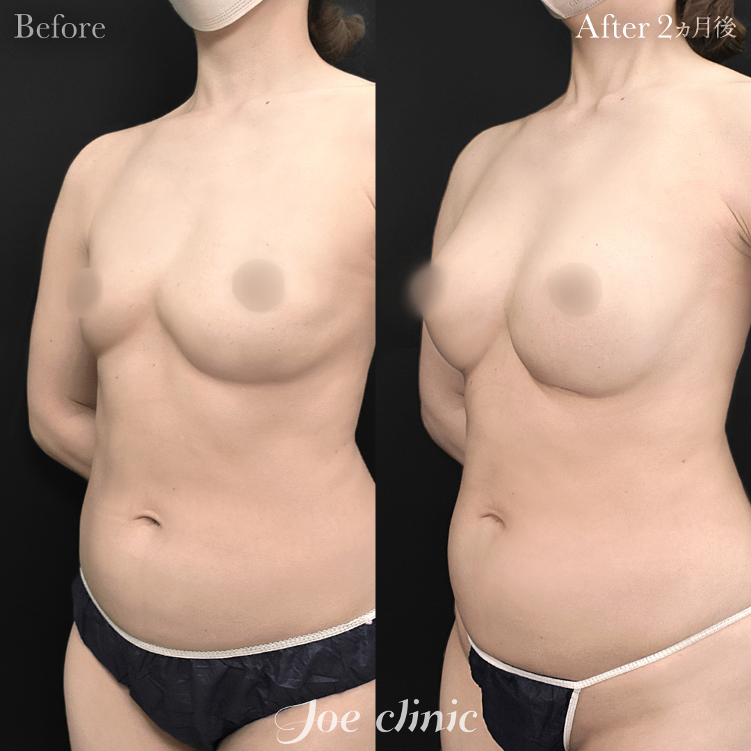 【40代女性・他院修正】アクアフィリング除去後のシリコンバッグ豊胸（275cc×左右）胸下切開 デュアルプレーン法｜2ヵ月後