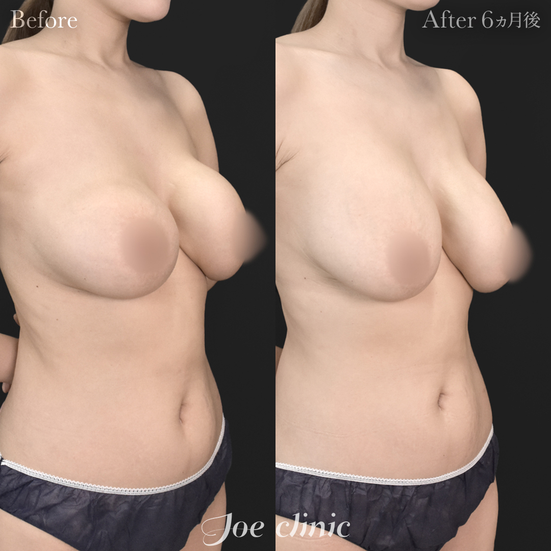 【40代女性・他院修正】他院変形バッグ入れ替え（300cc×左右）｜6ヵ月後