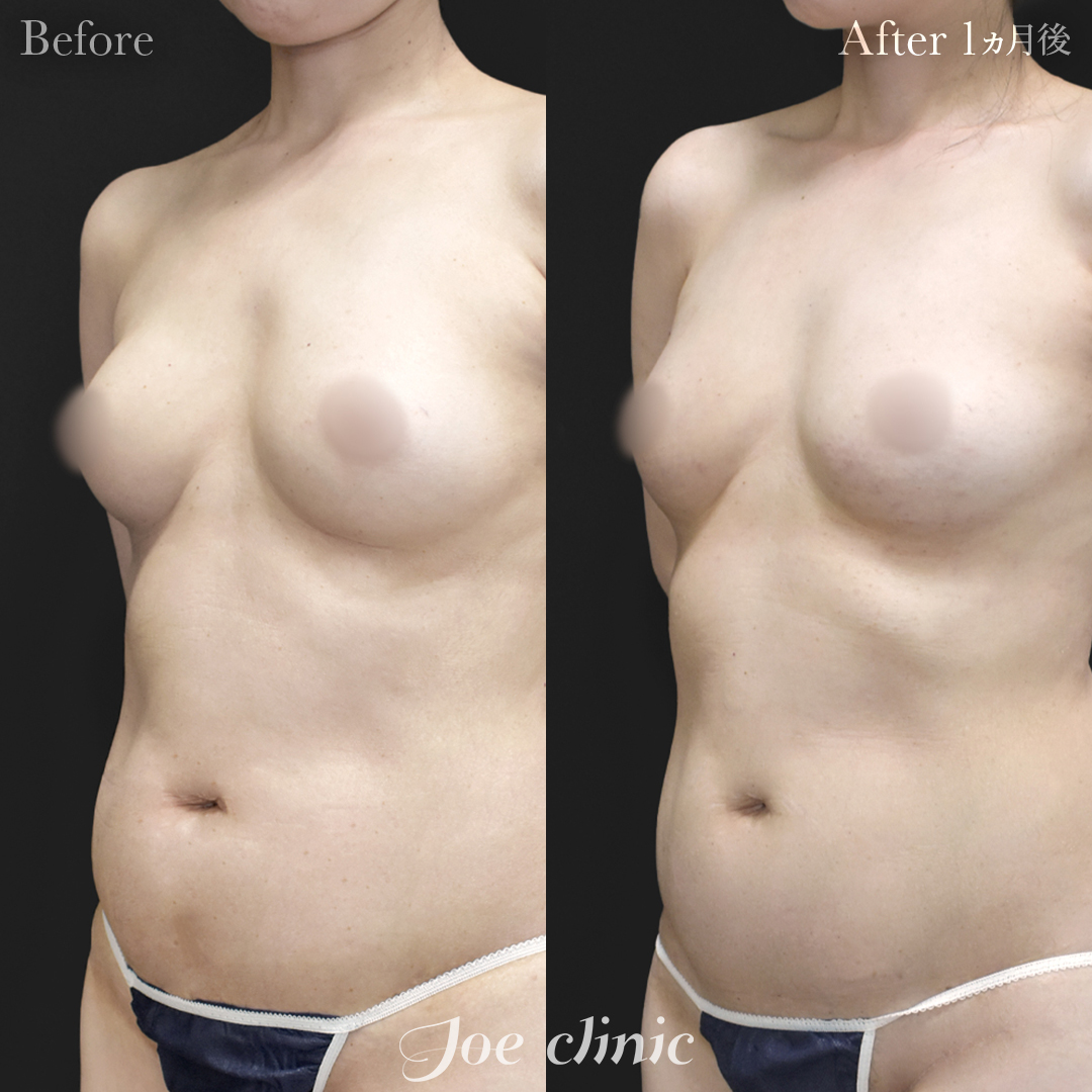 【40代女性・他院修正】他院バッグ抜去＋脂肪幹細胞注入豊胸｜1ヵ月後