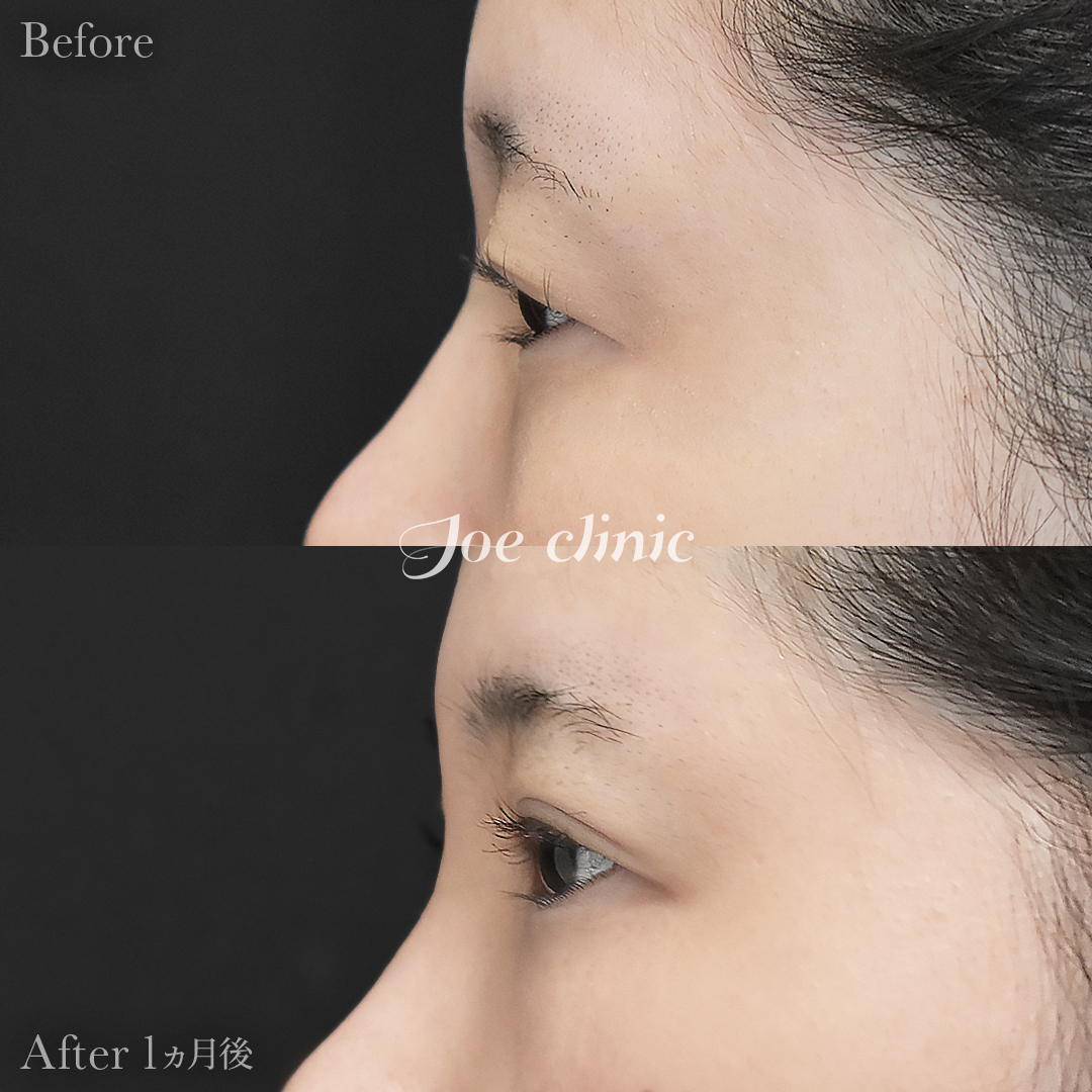 【20代女性】ジョウクリ式二重埋没法2点留め｜1ヵ月後