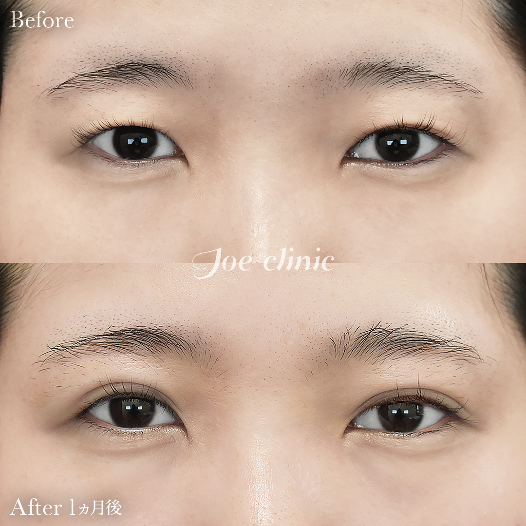 【20代女性】ジョウクリ式二重埋没法2点留め｜1ヵ月後