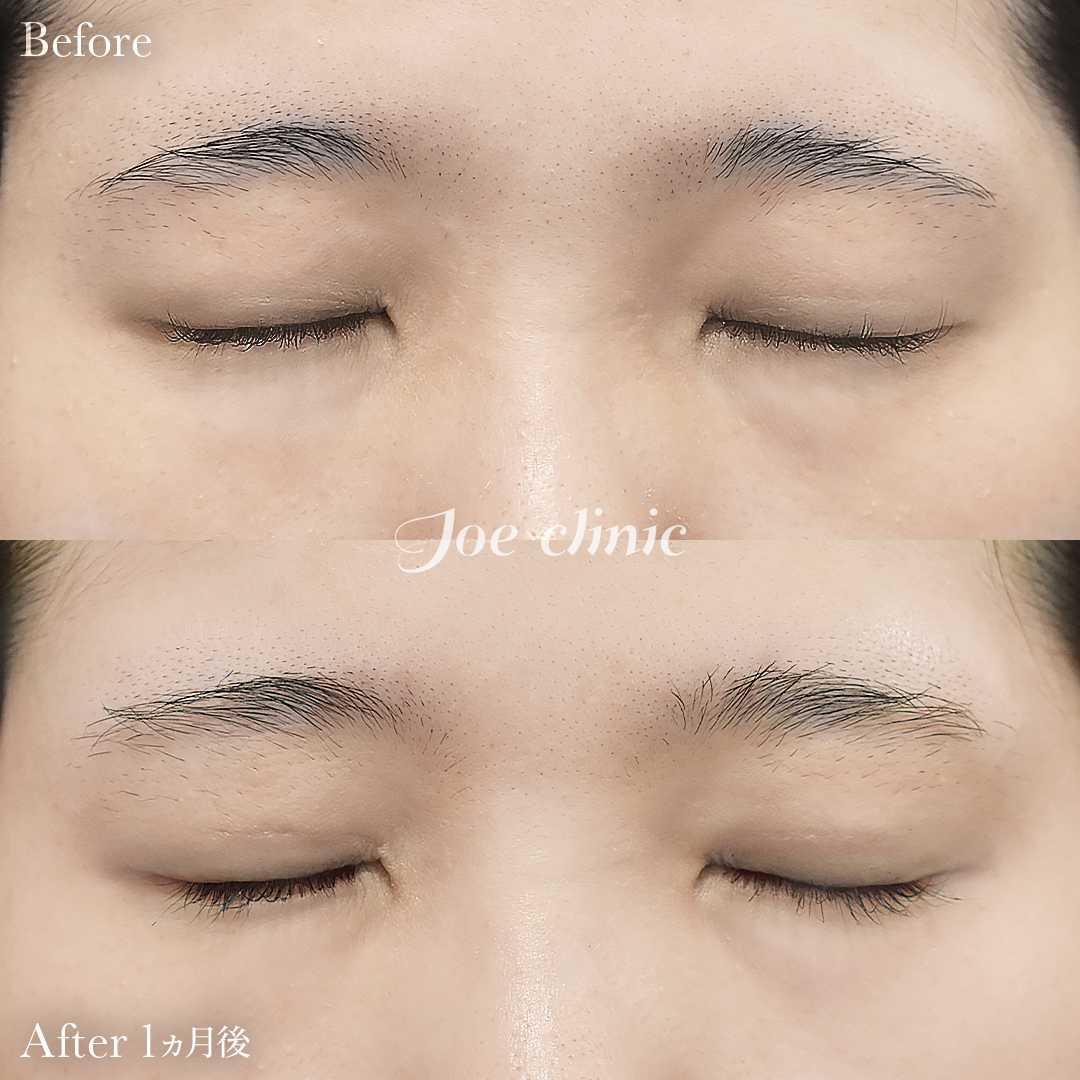 【20代女性】ジョウクリ式二重埋没法2点留め｜1ヵ月後