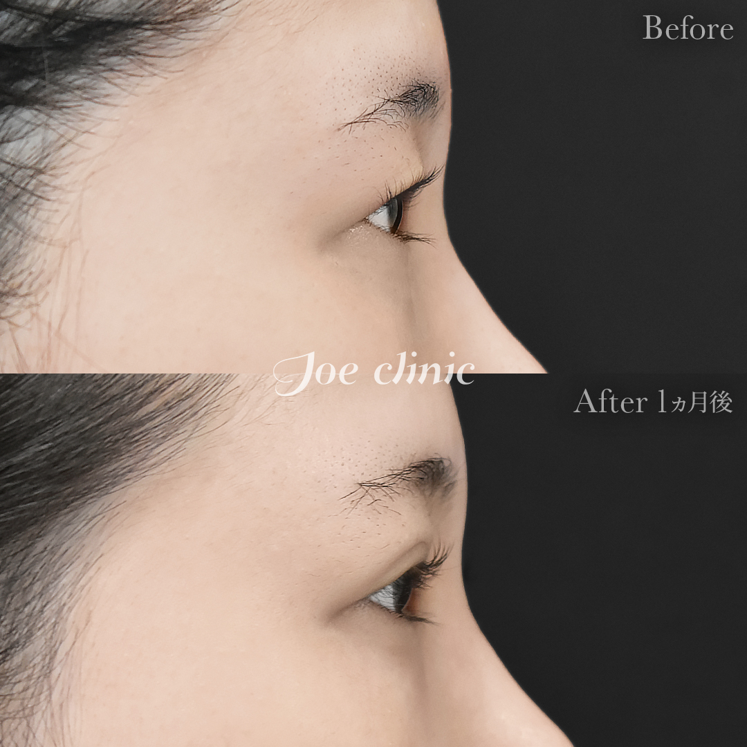 【20代女性】ジョウクリ式二重埋没法2点留め｜1ヵ月後