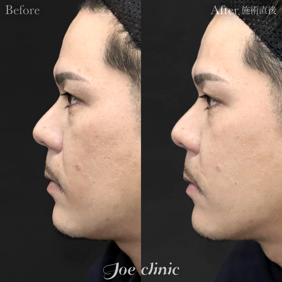 【30代男性】ヒアルロン酸注入（ほうれい線）｜施術直後