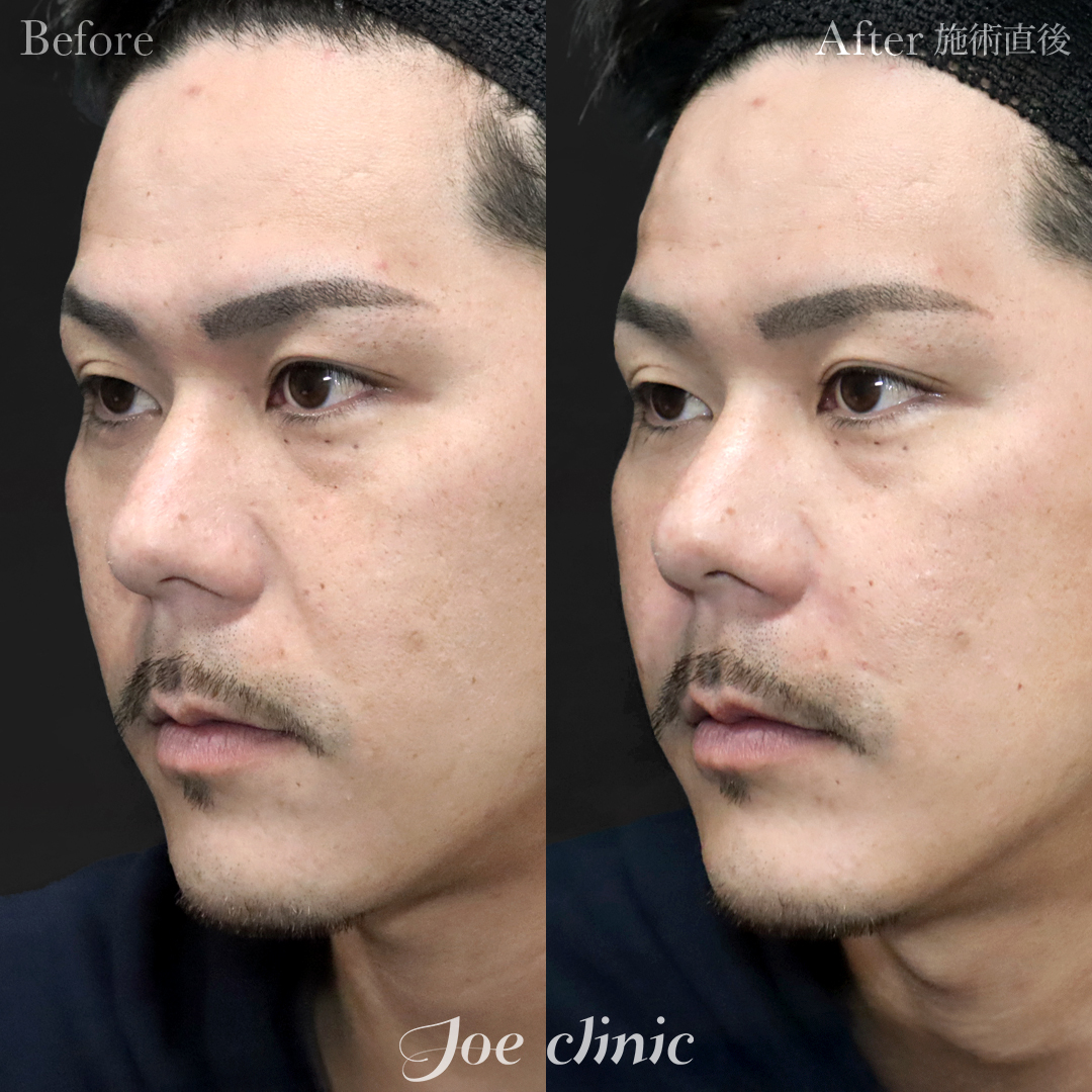 【30代男性】ヒアルロン酸注入（ほうれい線）｜施術直後