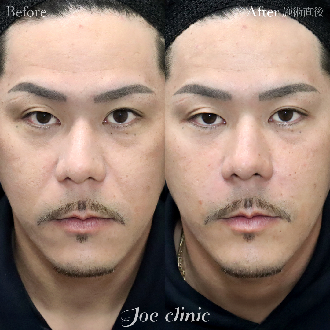 【30代男性】ヒアルロン酸注入（ほうれい線）｜施術直後