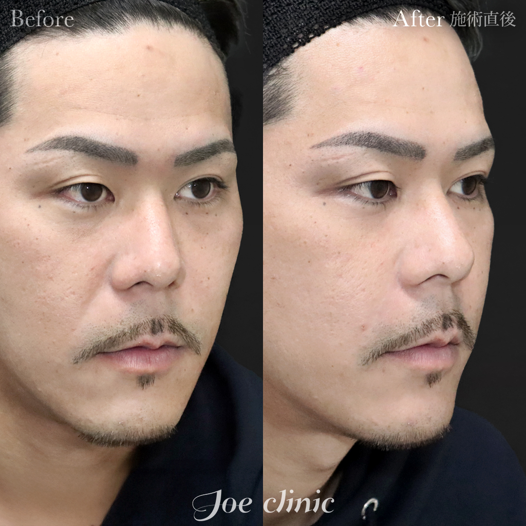 【30代男性】ヒアルロン酸注入（ほうれい線）｜施術直後