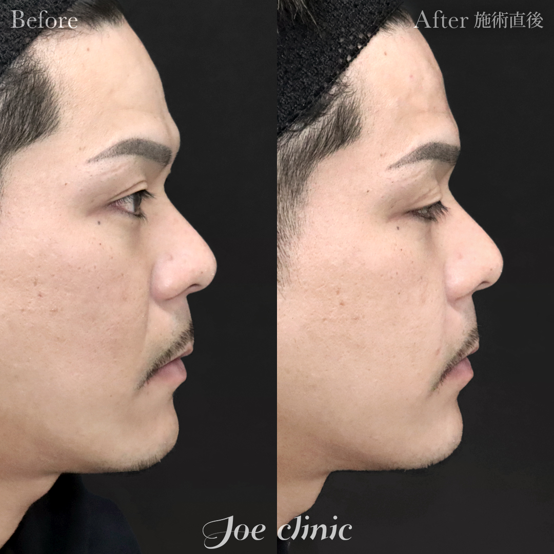 【30代男性】ヒアルロン酸注入（ほうれい線）｜施術直後